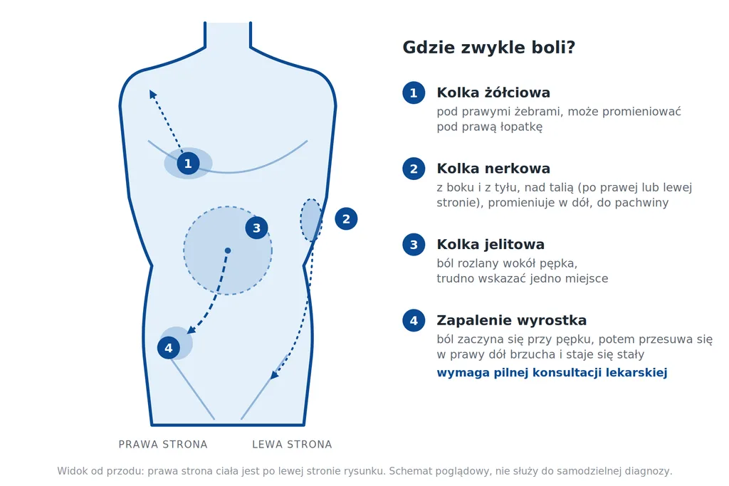 skurcze brzucha, skurczowy ból brzucha, ból brzucha skurczowy, Schemat brzucha z typowymi miejscami bólu przy kolce jelitowej, żółciowej i nerkowej oraz przy zapaleniu wyrostka robaczkowego.